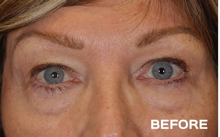 Upper and Lower Blepharoplasty before and after - before