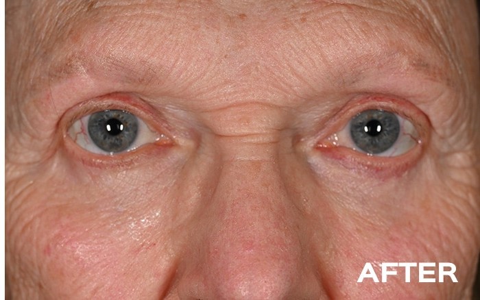 Upper and Lower Blepharoplasty with Fat Repositioning before and after - after