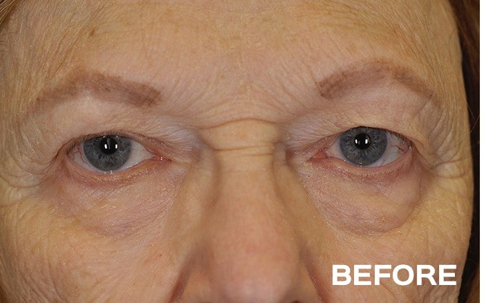 Upper and Lower Blepharoplasty with Fat Repositioning before and after - before