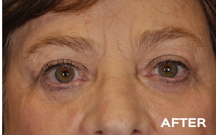 Upper and Lower Blepharoplasty with Fat Repositioning before and after - after