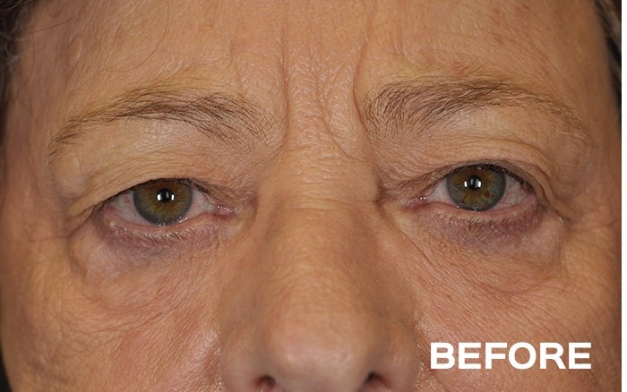 Upper and Lower Blepharoplasty with Fat Repositioning before and after - before