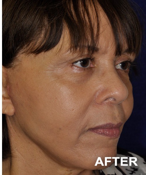 Facelift after — Dr. Harry Marshak