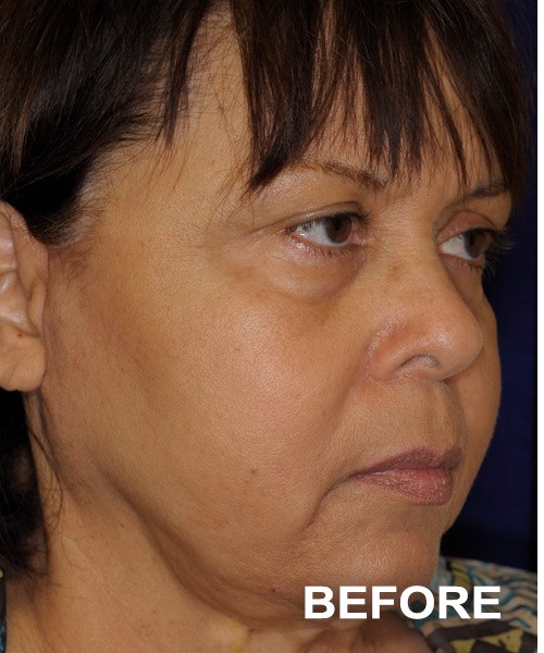 Facelift before — Dr. Harry Marshak