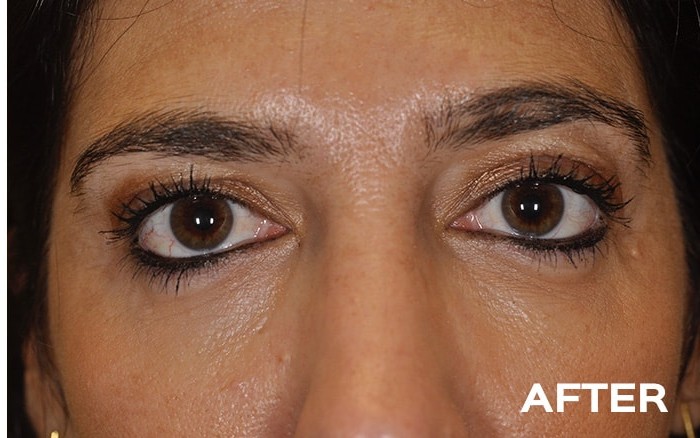 Lower Blepharoplasty with Fat Repositioning before and after - after