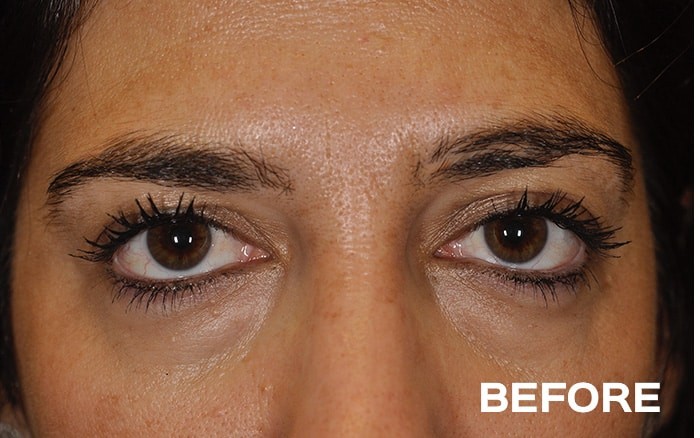 Lower Blepharoplasty with Fat Repositioning before and after - before