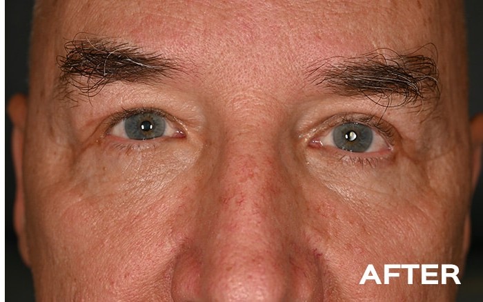 Lower Blepharoplasty with Fat Repositioning before and after - after