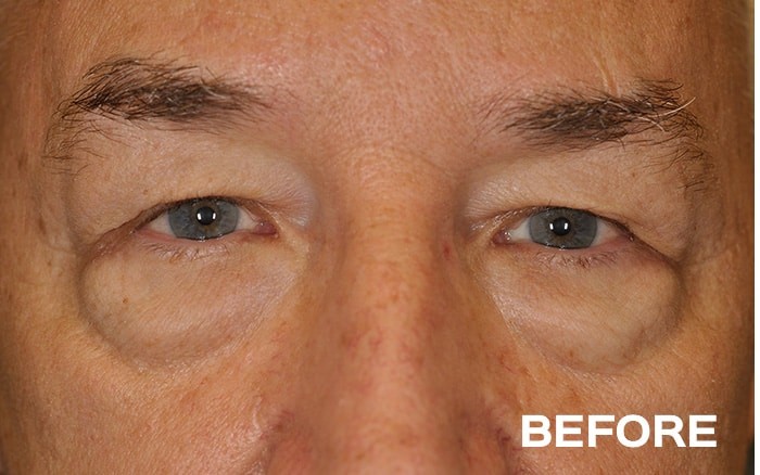 Lower Blepharoplasty with Fat Repositioning before and after - before