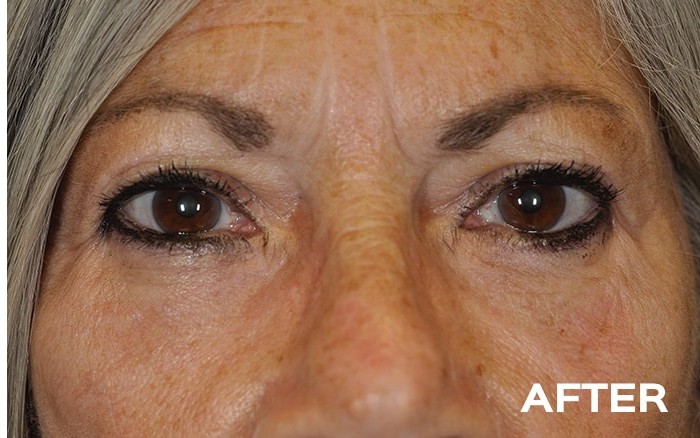 Transconjunctival Lower Blepharoplasty with Fat Repositioning before and after - after