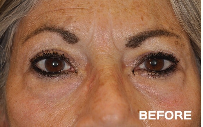 Transconjunctival Lower Blepharoplasty with Fat Repositioning before and after - before