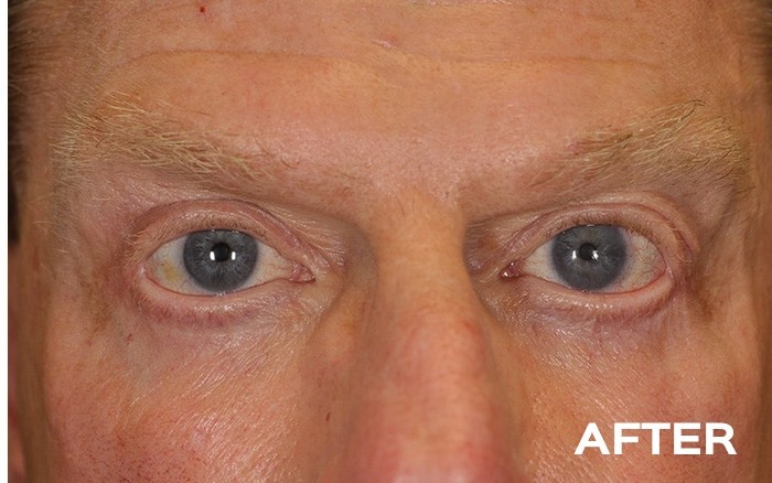 Transconjunctival Lower Blepharoplasty with Fat Repositioning before and after - after