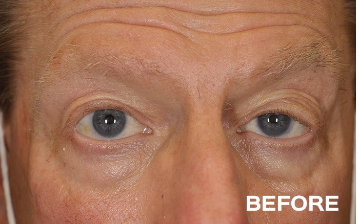 Transconjunctival Lower Blepharoplasty with Fat Repositioning before and after - before