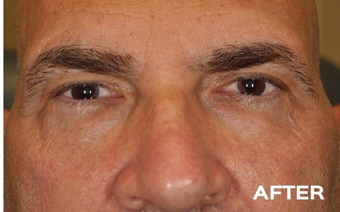 Lower Blepharoplasty with Fat Repositioning before and after - after