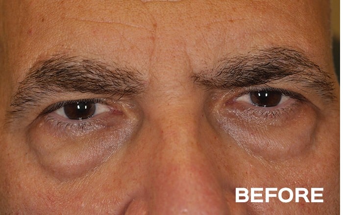 Lower Blepharoplasty with Fat Repositioning before and after - before