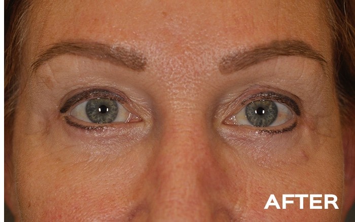 Lower Blepharoplasty with Fat Repositioning before and after - after