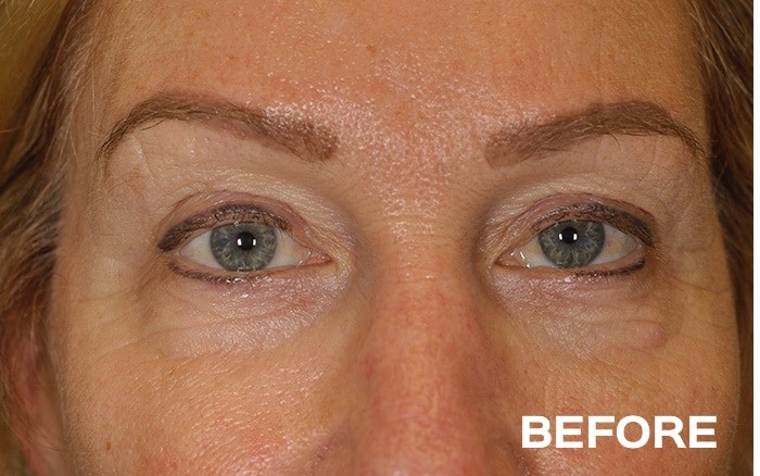 Lower Blepharoplasty with Fat Repositioning before and after - before