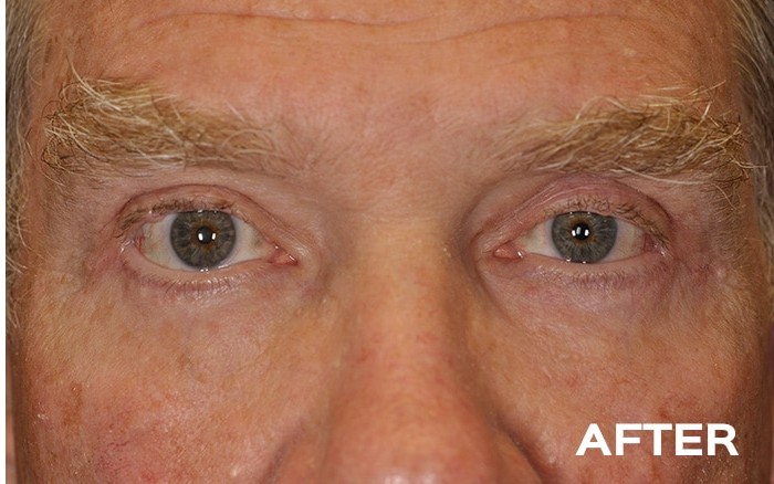 Upper Blepharoplasty, Transconjunctival Lower Blepharoplasty with Fat Repositioning and Left Browpexy before and after - after