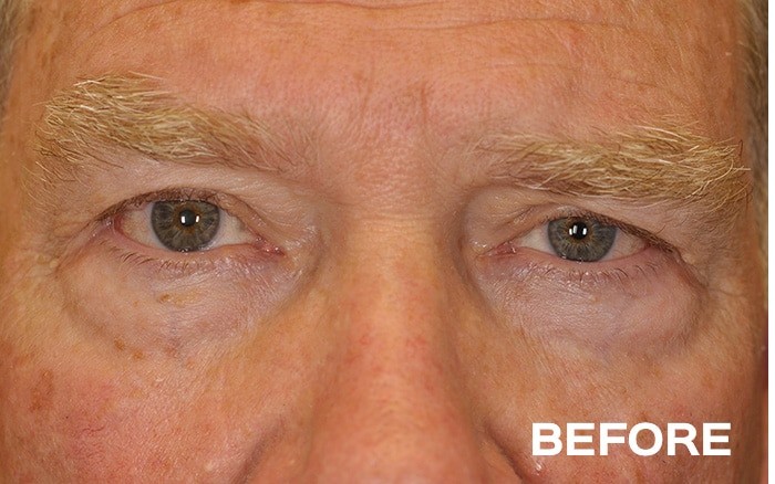 Upper Blepharoplasty, Transconjunctival Lower Blepharoplasty with Fat Repositioning and Left Browpexy before and after - before