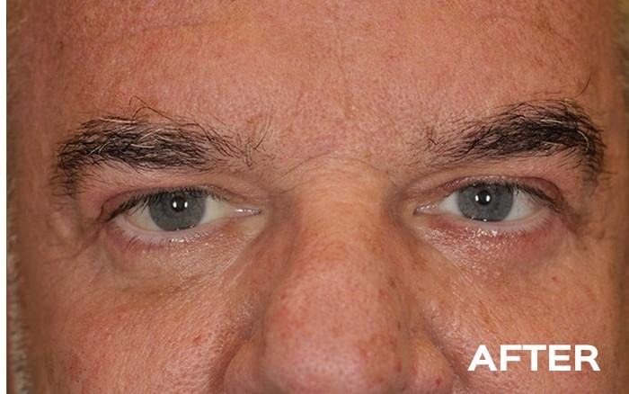 Upper Blepharoplasty, Transconjunctival Lower Blepharoplasty with Fat Repositioning and Left Browpexy before and after - after
