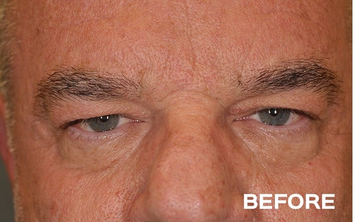 Upper Blepharoplasty, Transconjunctival Lower Blepharoplasty with Fat Repositioning and Left Browpexy before and after - before
