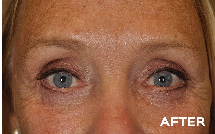 Temple Browlift, Medial Upper Blepharoplasty and Lower Blepharoplasty with Fat Repositioning before and after - after