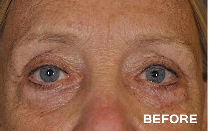 Temple Browlift, Medial Upper Blepharoplasty and Lower Blepharoplasty with Fat Repositioning before and after - before