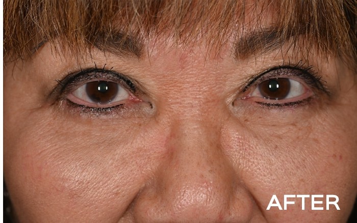 Temple Browlift, Medial Upper Blepharoplasty and Lower Blepharoplasty with Fat Repositioning before and after - after