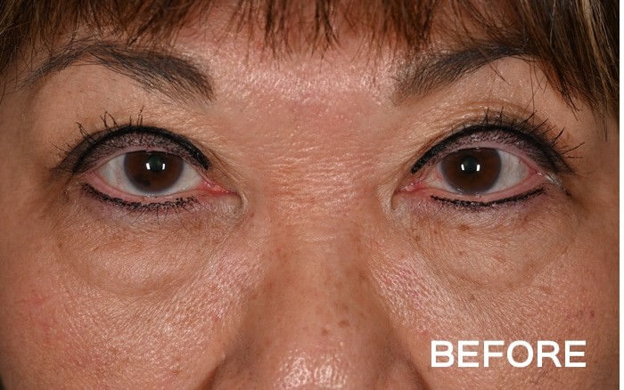 Temple Browlift, Medial Upper Blepharoplasty and Lower Blepharoplasty with Fat Repositioning before and after - before