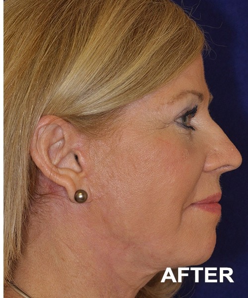 Facelift after — Dr. Harry Marshak