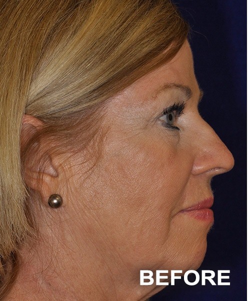 Facelift before — Dr. Harry Marshak