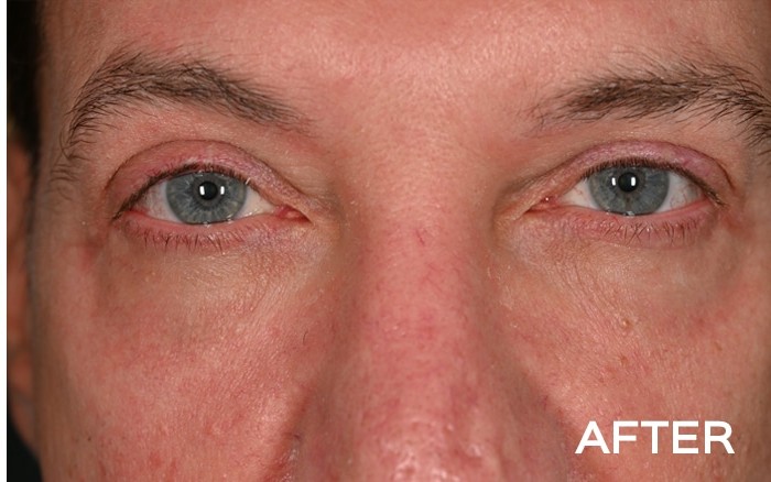 Transconjunctival Lower Blepharoplasty with Fat Repositioning before and after - after