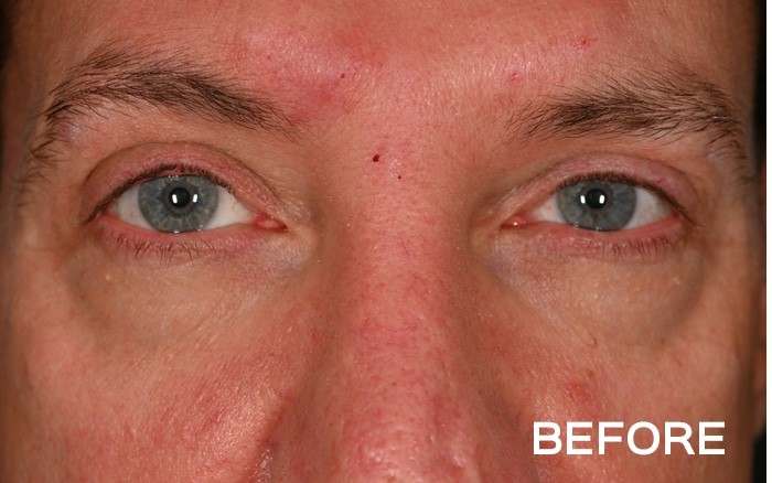 Transconjunctival Lower Blepharoplasty with Fat Repositioning before and after - before