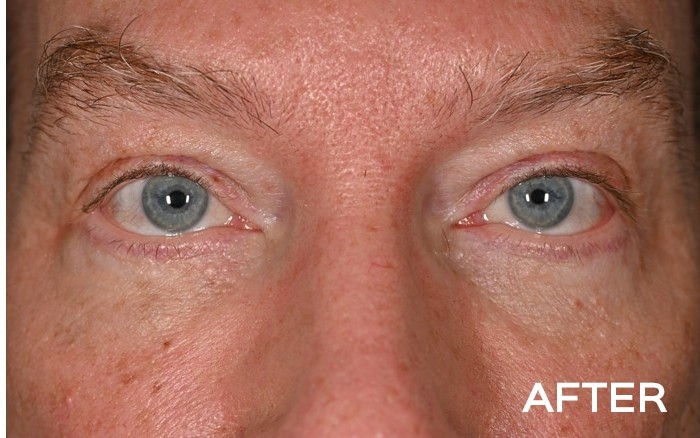 Transconjunctival Lower Blepharoplasty with Fat Repositioning before and after - after