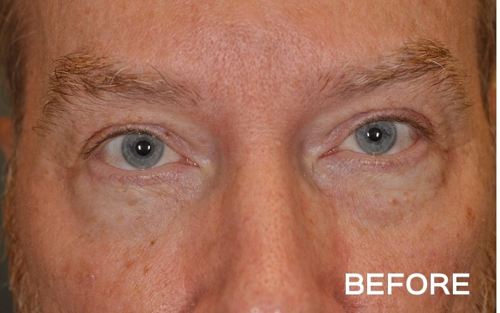 Transconjunctival Lower Blepharoplasty with Fat Repositioning before and after - before