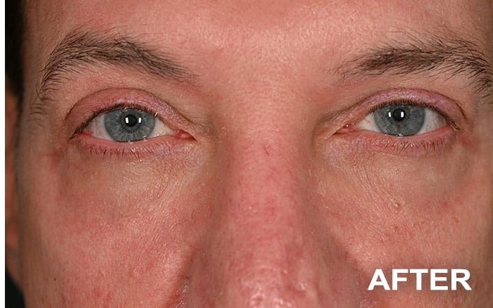 Transconjunctival Lower Blepharoplasty with Fat Repositioning before and after - after