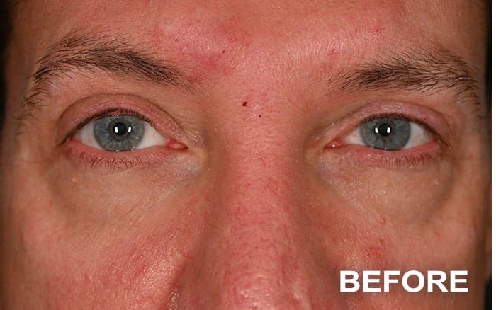 Transconjunctival Lower Blepharoplasty with Fat Repositioning before and after - before