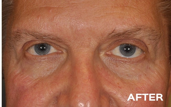 Transconjunctival Lower Blepharoplasty with Fat Repositioning before and after - after