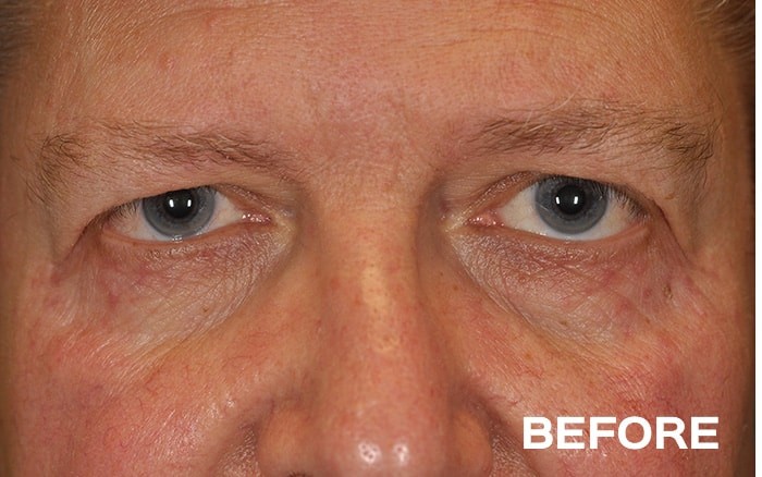 Transconjunctival Lower Blepharoplasty with Fat Repositioning before and after - before