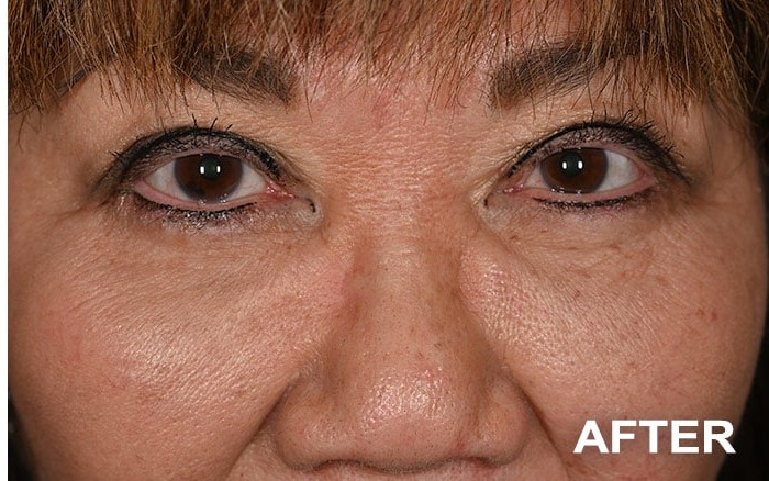 Upper Blepharoplasty and Lower Blepharoplasty with Fat Repositioning before and after - after