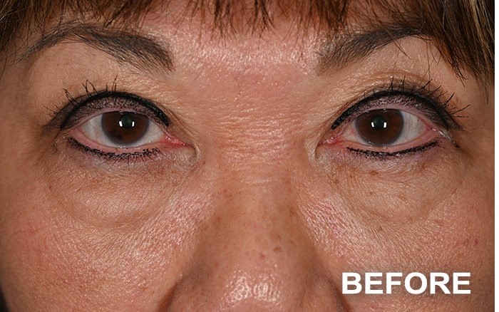 Upper Blepharoplasty and Lower Blepharoplasty with Fat Repositioning before and after - before