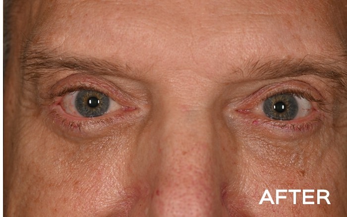 Upper Blepharoplasty and Lower Blepharoplasty with Fat Repositioning before and after - after