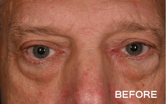 Upper Blepharoplasty and Lower Blepharoplasty with Fat Repositioning before and after - before