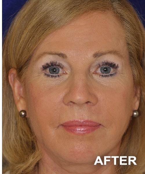 Facelift after — Dr. Harry Marshak