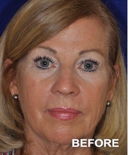 Facelift before — Dr. Harry Marshak