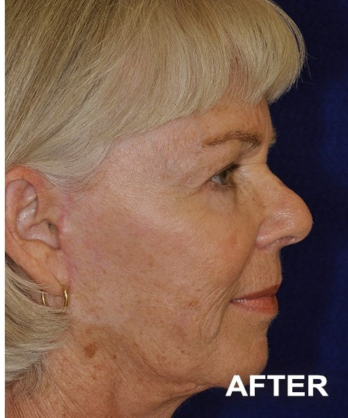 Facelift after — Dr. Harry Marshak