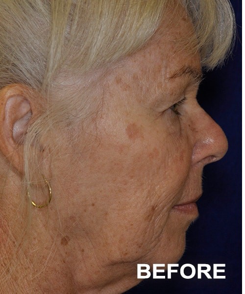 Facelift before — Dr. Harry Marshak