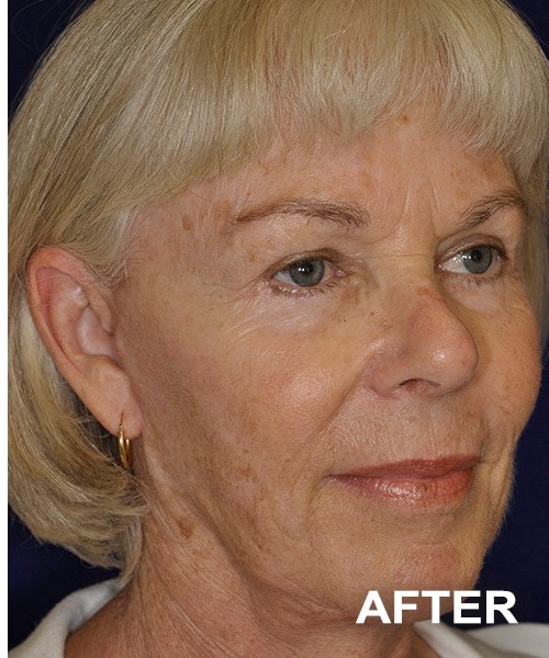 Facelift after — Dr. Harry Marshak