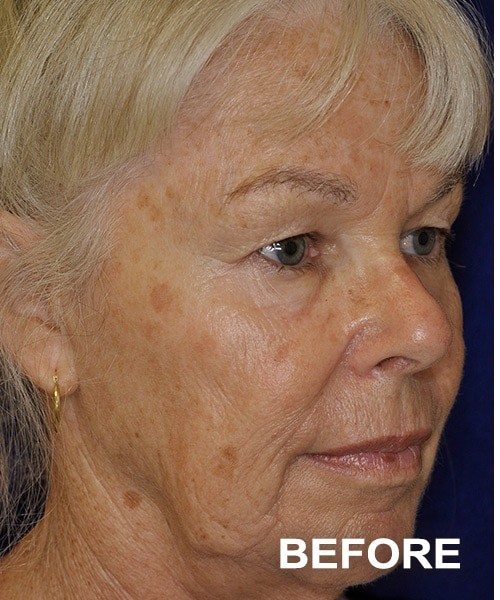Facelift before — Dr. Harry Marshak