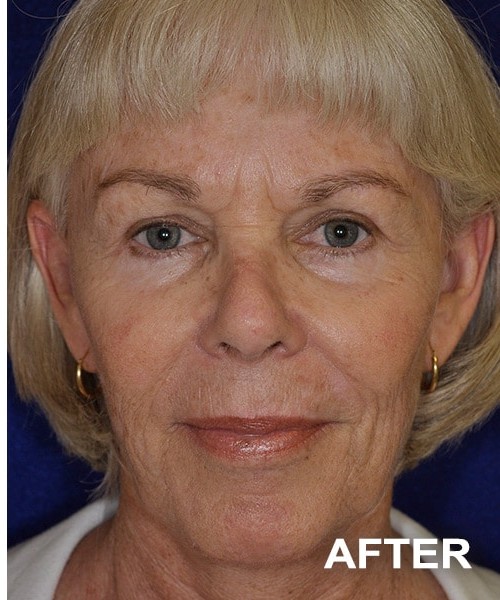 Facelift after — Dr. Harry Marshak