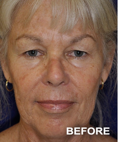 Facelift before — Dr. Harry Marshak