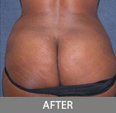Liposuction before and after - after